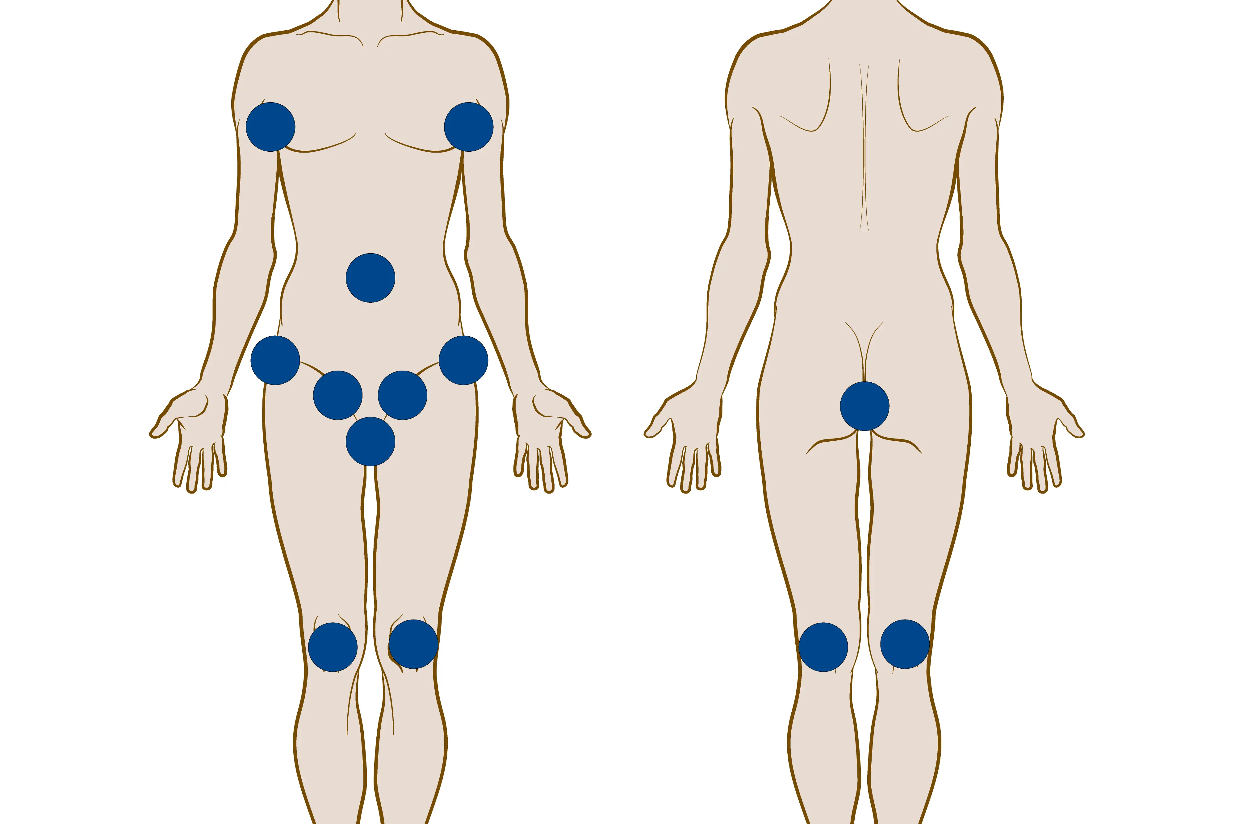 Illustrasjon av hvor på kroppen det må vaskes før operasjon